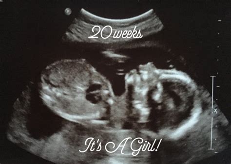 20 Week Ultrasound And Gender Reveal Babycenter