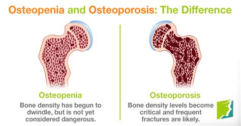Osteopenia And Osteoporosis The Difference Menopause Now