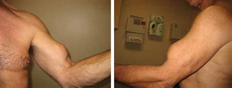 When Is A Conservative Approach Best For Proximal Biceps