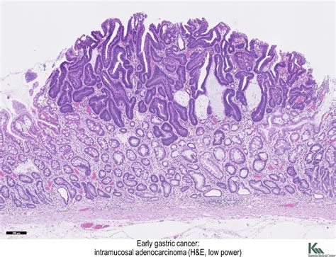 Pathology Outlines Carcinoma General