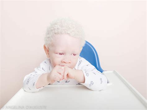 Fit Photographer Angelina D Auguste S Photo Series On Albinism