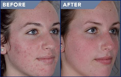 Acne Treatment Photos Soderstrom Skin Institute
