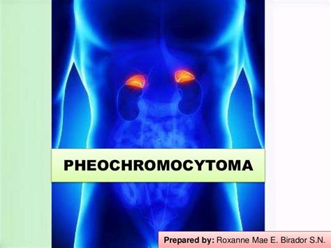Pheochromocytoma