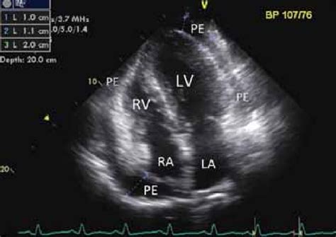 Echocardiogram In Apical 4 Chamber Window Shows Circumferential