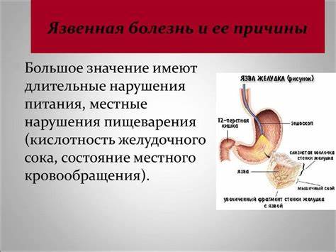 Язва Желудка Симптомы Лечение И Диета — Похудение Диета Правильное Питание Картинка - Язва Желудка Симптомы Лечение И Диета — Похудение Диета Правильное Питание