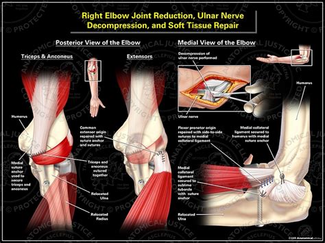 Right Elbow Joint Reduction Ulnar Nerve Decompression
