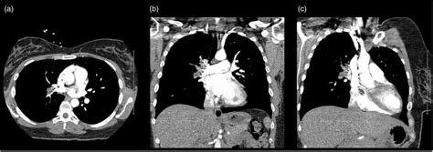 Computed Tomography Ct Scan Of The Chest With Contrast Ct Scan Of