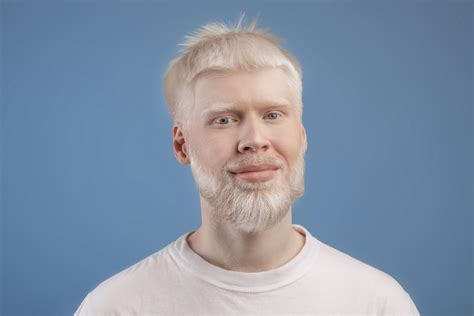 Albinism Types Causes Symptoms And Treatment Askapollo Blogs