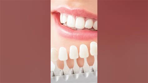 Proper Dental Crown Procedure 5 Useful Aftercare Tips Youtube
