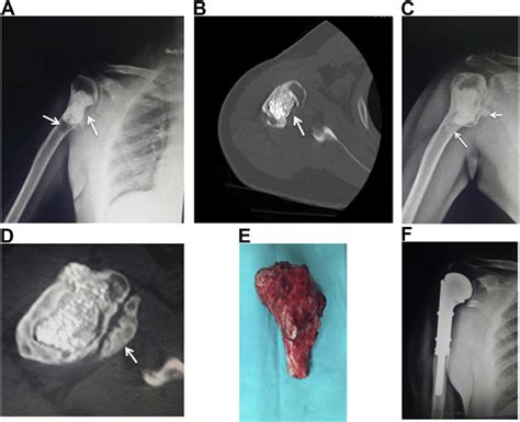 Year Old Man With Giant Cell Tumor Of Proximal Humerus Previously