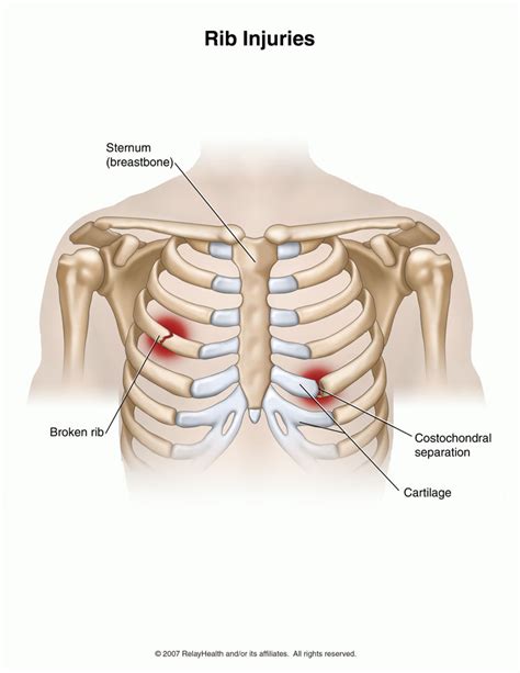 They will listen to and examine your chest to determine if they think you have a broken rib. Rib Injury. Causes, symptoms, treatment Rib Injury