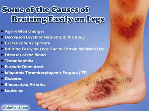 Causes Of Bruising Easily On Legs And Ways To Deal With It