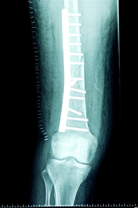 Pinned Femur Bone Of The Leg Photograph By Dr P Marazziscience Photo