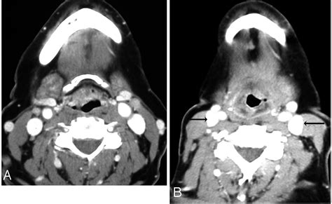 Selective Neck Dissection Ct And Mr Imaging Findings American