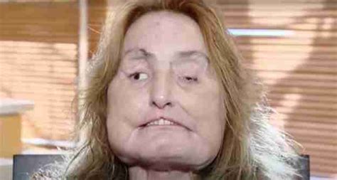 Connie Culp Became The First Ever Face Transplant Patient In The Us Inside Her Remarkable Story