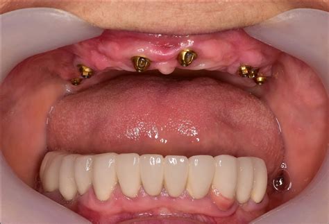 Fixed Implant Denture Athens GA Watkinsville GA Hall Dental