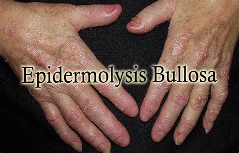 Junctional Epidermolysis Bullosa Associated With Kidney Urinary Tract