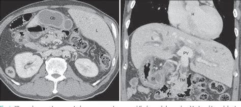 Figure 1 From Pancreaticoduodenectomy Performed In A Patient With Situs