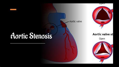 Severe Aortic Stenosis Time For Intervention Youtube
