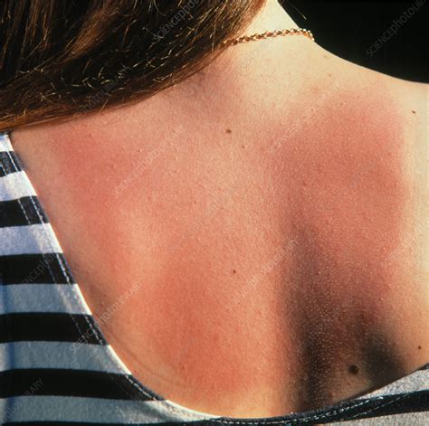 Red Skin On The Back Of A Sunburnt Woman Stock Image M335 0108