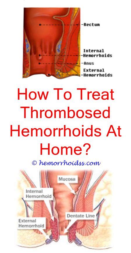 Pin On How To Heal Hemorrhoids