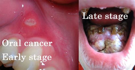 Oral Cancer Symptoms Diagnosis Treatment And Prevention