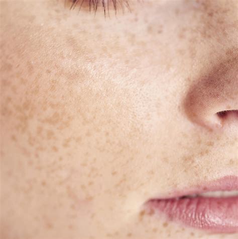 Freckles And Age Spots Removal Assurance Skin Clinic