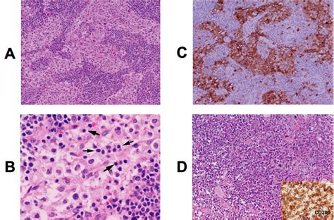 Concomitant Sinus Histiocytosis With Massive Lymphadenopathy Rosai