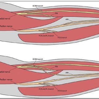 Distal Median Nerve Deficit Transfer Of The Terminal Branch Of The