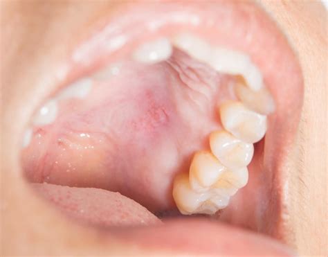 What Causes A Bump On The Roof Of The Mouth Mouth Ulcers Roof Of