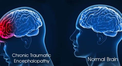 What Is Chronic Traumatic Encephalopathy Cte Healthtian