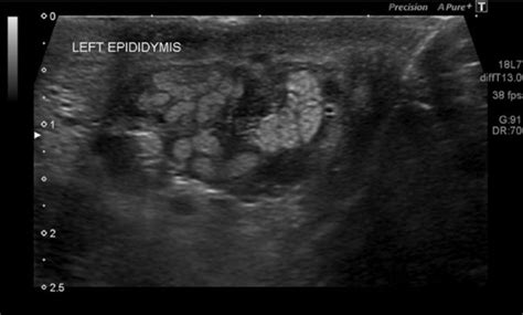 Transverse Sonogram Of The Left Scrotum Shows The Thrombosis Of The