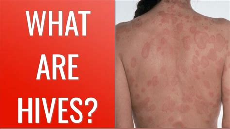 Pin On How To Get Rid Of Hives Fast
