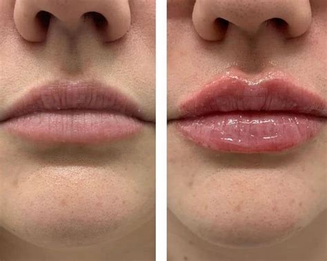 Some Known Details About Botox Lip Flip San Diego Glow Theory Med Spa