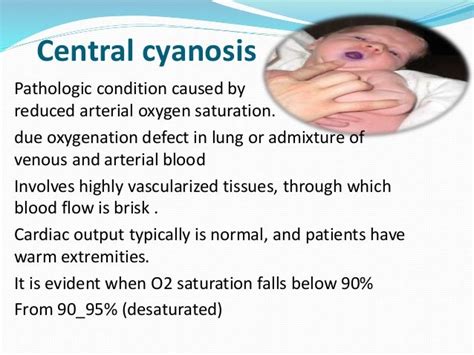 Child With Cyanosis