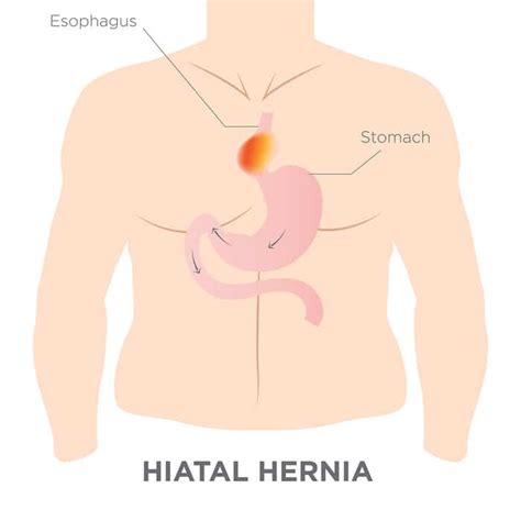Hiatal Hernia Treatment Alternative Drmcare