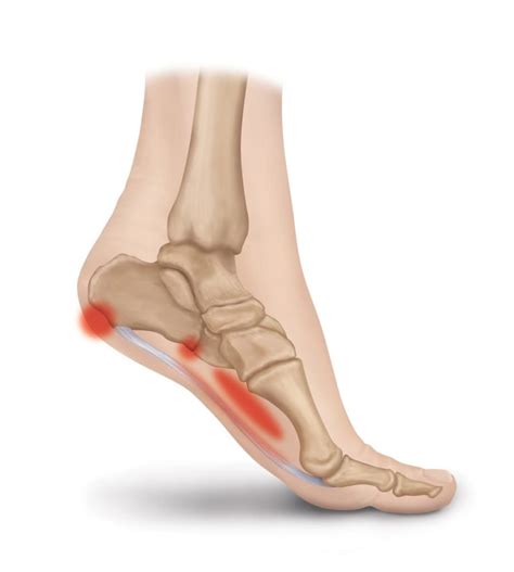 Plantar fasciitis, inflammation of the ligament that runs under the sole of the foot, is one of the most common causes of heel pain. Plantar Fascia Ligament & Pain Conditions | Heel That Pain