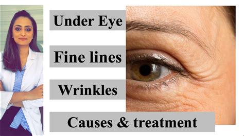 Fine Lines Wrinkles Under Eye Causes And Treatment Prevention Dr