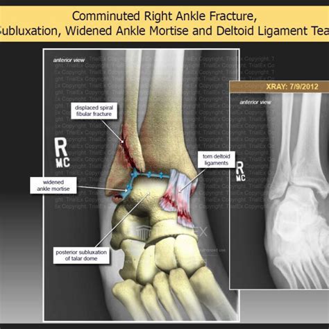 Comminuted Right Ankle Fracture Trialexhibits Inc
