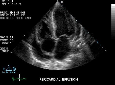 Pericarditis With Fluid Heart Ultrasound Diagnostic Medical
