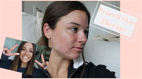 This Acne Treatment Saved My Skin Youtube