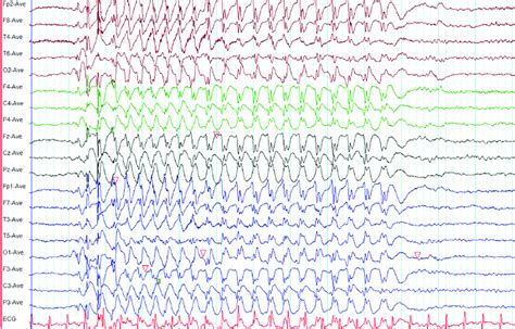 Electroencephalography Eeg Of A Myoclonic Absence Seizure Note The