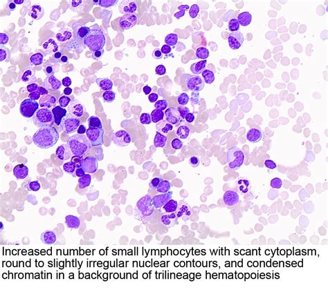 Pathology Outlines Leukemic Nonnodal Mantle Cell Lymphoma