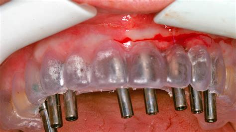 La Carga Inmediata Con Implantes Microdent En El Maxilar Superior