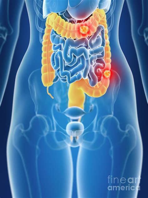 illustration of female colon cancer photograph by sebastian kaulitzki science photo library pixels