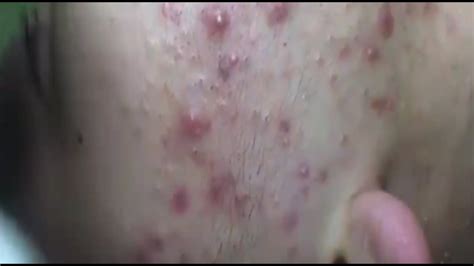 Remove Inflamed Cystic Acne Treatment Blackheads Treatment Youtube