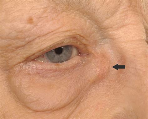 Lacrimal Sac Mucocele British Journal Of Ophthalmology