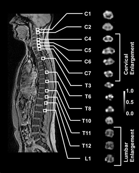 Diffusion Tensor Mr Imaging Of The Neurologically Intact Human Spinal