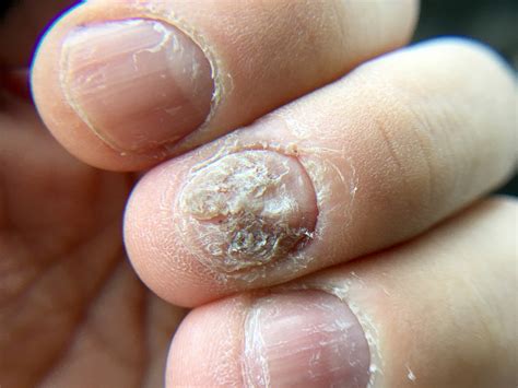 Fingernail Diseases