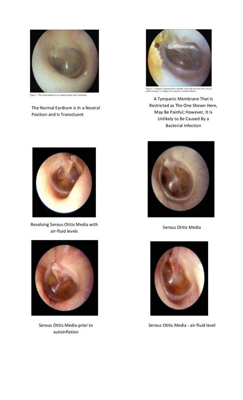 Tympanic Membrane Dr Fadil